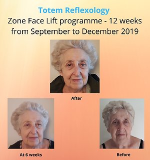 ZONE FACE LIFT. ZFLcasestudy
